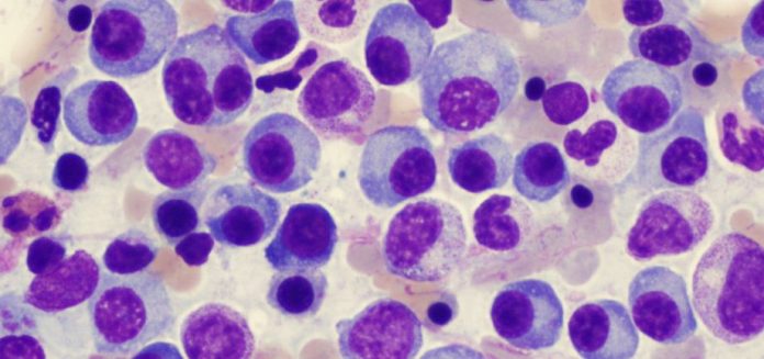 multiple_myeloma_prognosis