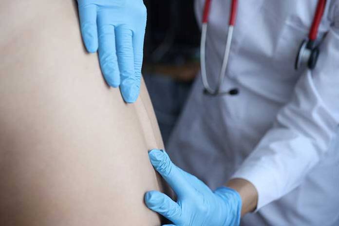 Should You Join a Hernia Mesh Lawsuit? Should You Join a Hernia Mesh Lawsuit?
