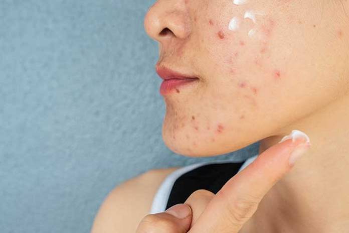 3 Things You Can Do to Reduce Acne Flare-Ups 3 Things You Can Do to Reduce Acne Flare-Ups