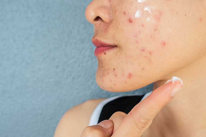 3 Things You Can Do to Reduce Acne Flare-Ups