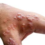 CDC Finds Monkeypox Virus Survives On Household Items and Surfaces