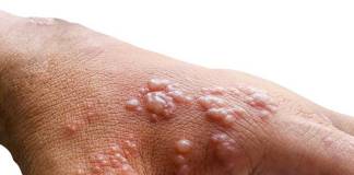 CDC Finds Monkeypox Virus Survives On Household Items and Surfaces