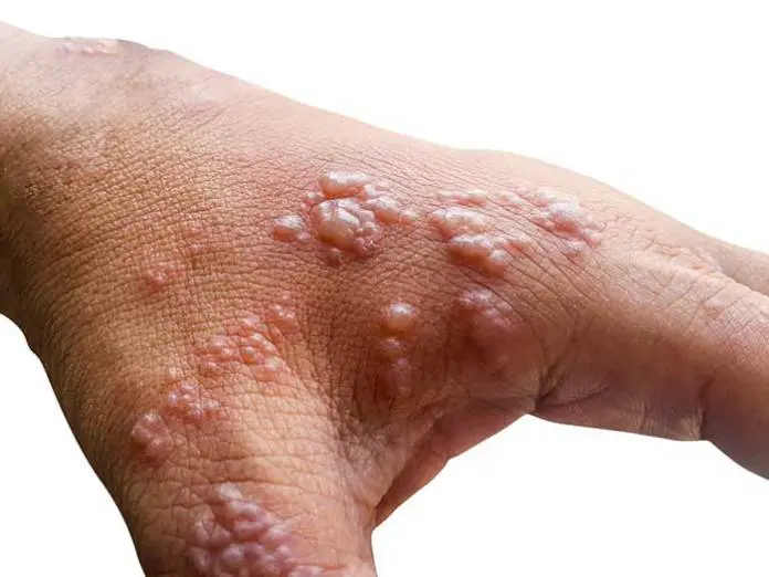 CDC Finds Monkeypox Virus Survives On Household Items and Surfaces CDC Finds Monkeypox Virus Survives On Household Items and Surfaces