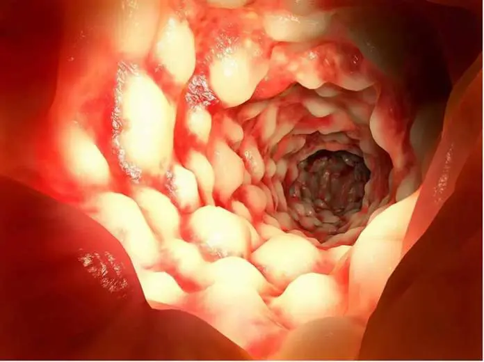 Scientists Discover Why Some People Develop Crohn’s Disease and Others Do Not Scientists Discover Why Some People Develop Crohn’s Disease and Others Do Not